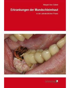 Erkrankungen der Mundschleimhaut Image 1